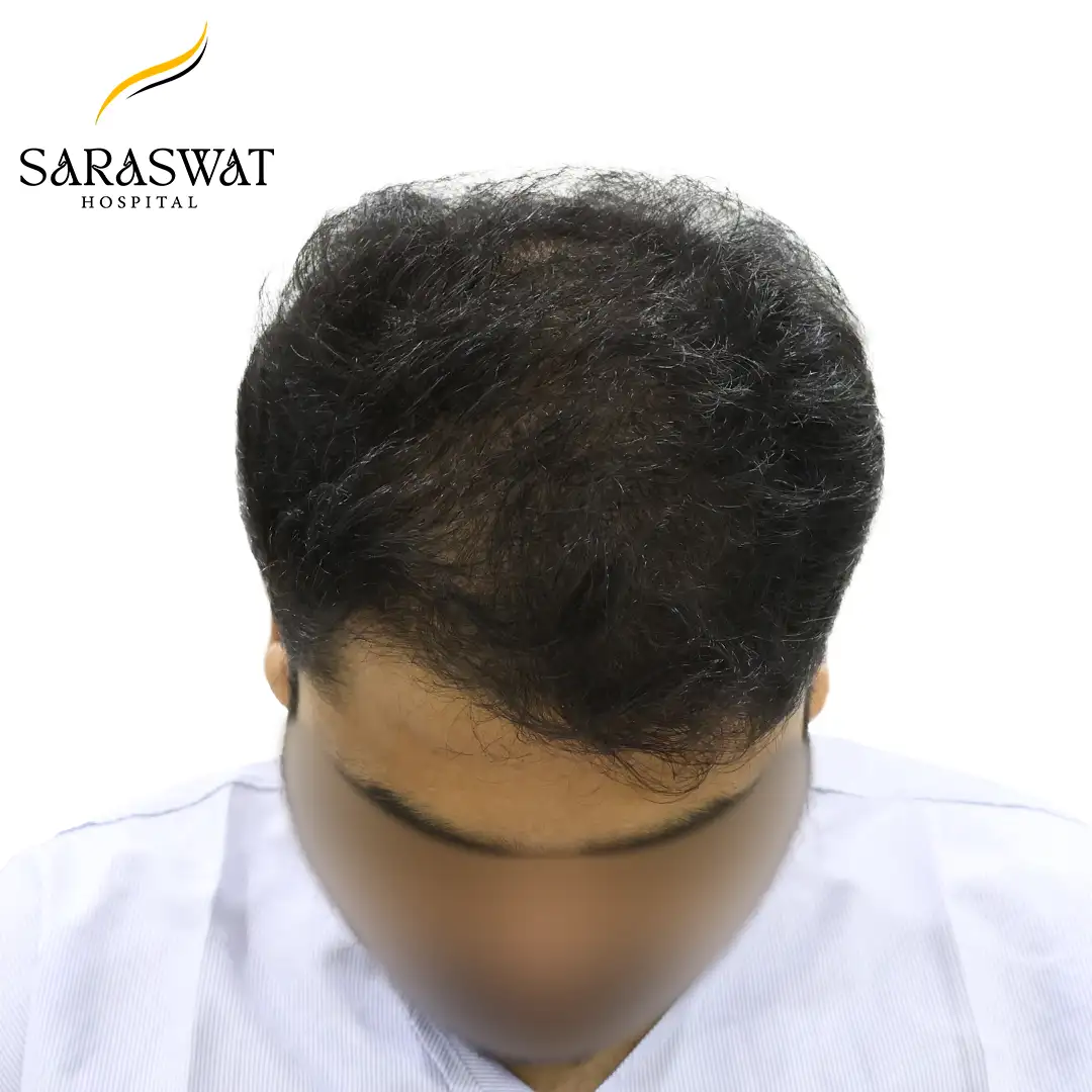 Top FUE Hair Transplant Result Before Procedure