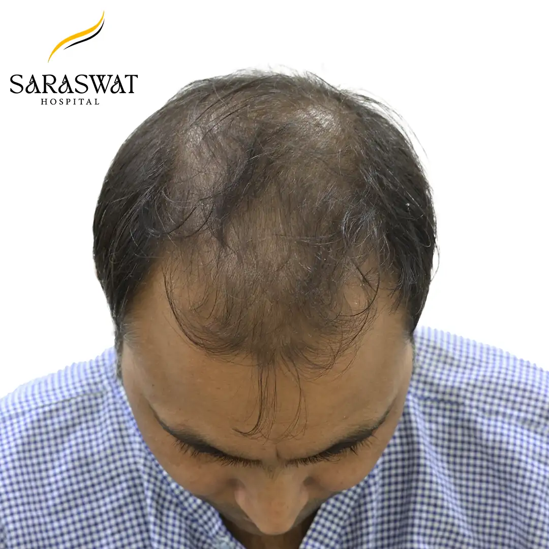 Top FUE Hair Transplant Result Before Procedure