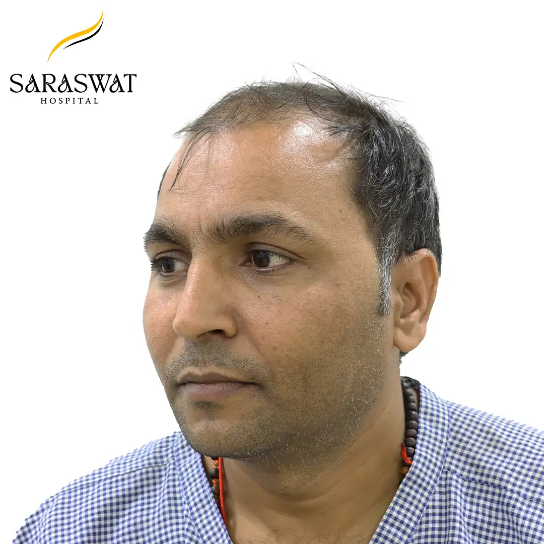 45 Degree Left FUE Hair Transplant Result Before Procedure