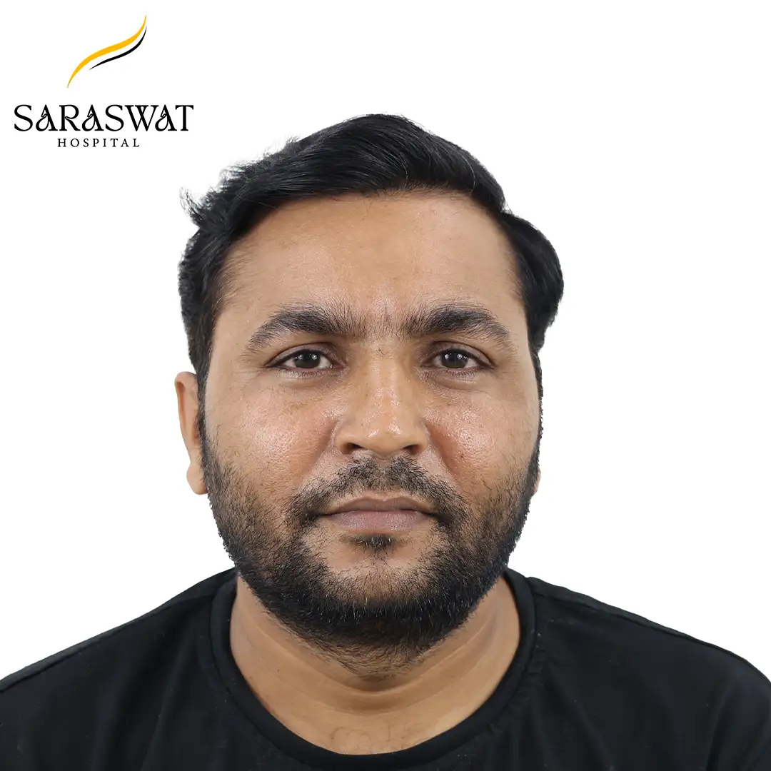 Hair Transplant Before and After