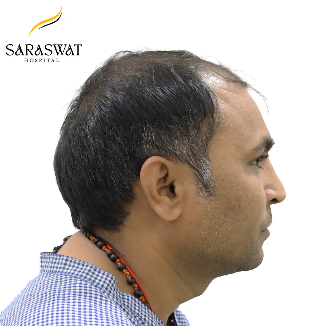 90 Degree Right FUE Hair Transplant Result Before Procedure