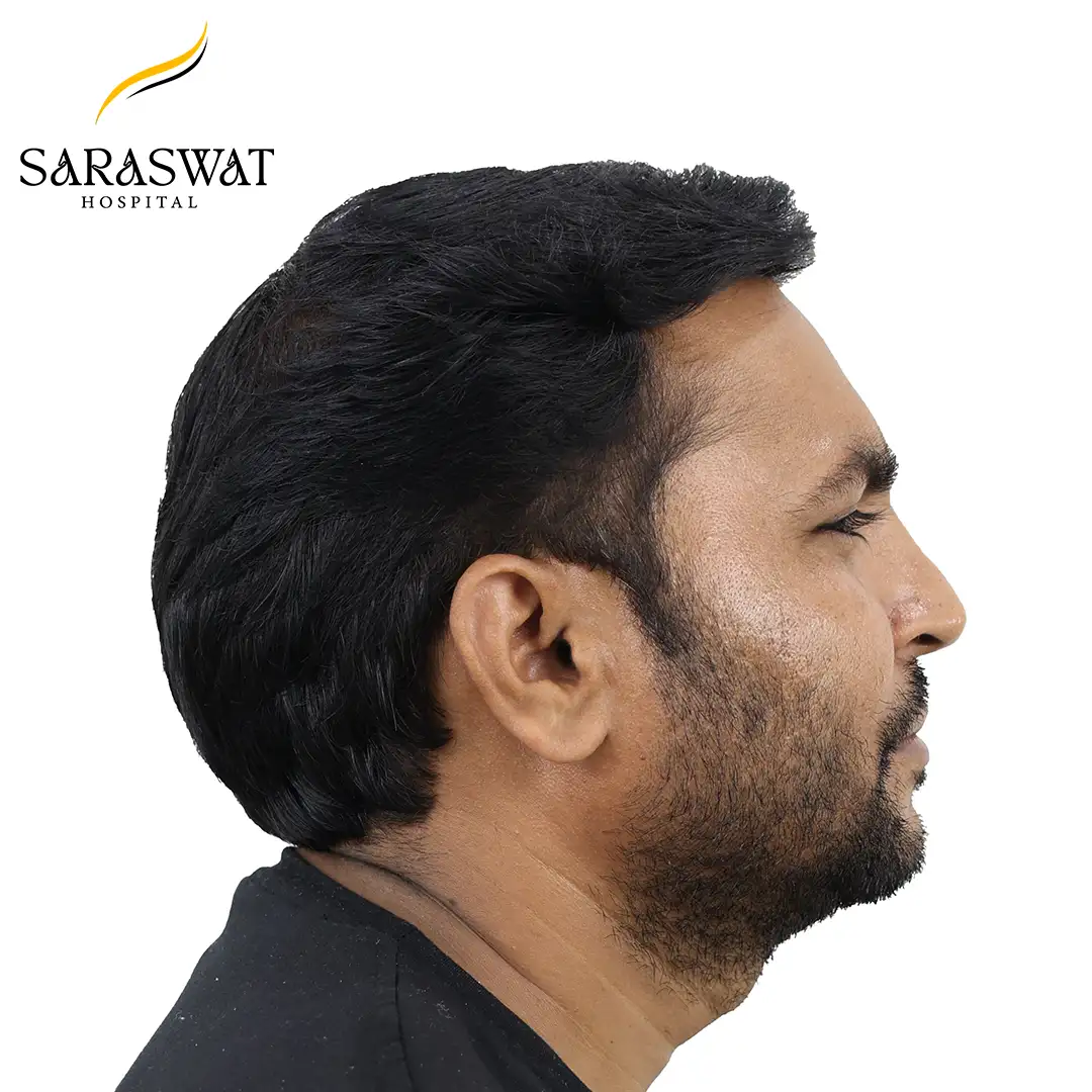 90 Degree Right FUE Hair Transplant Result After Procedure