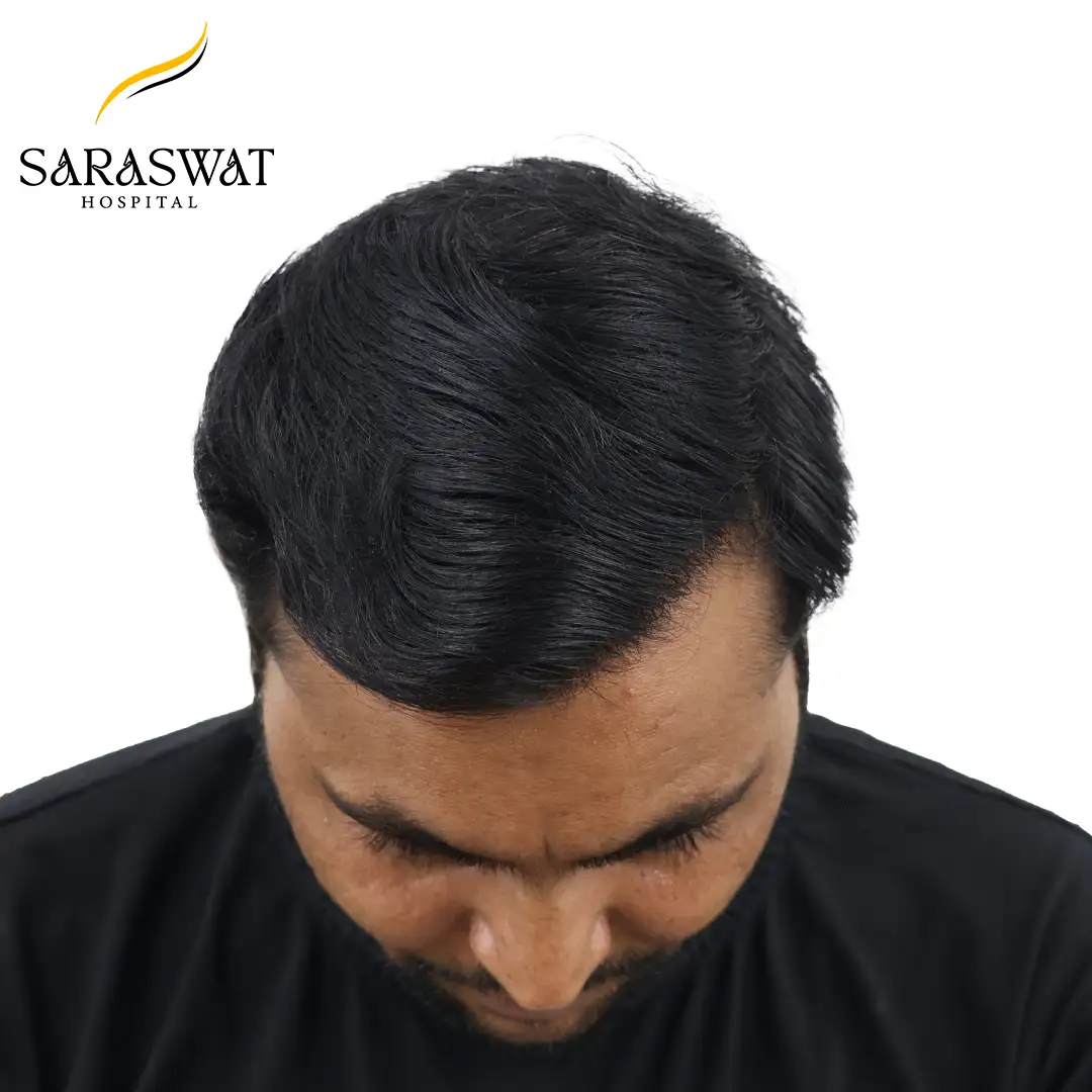 Hair Transplant Before After