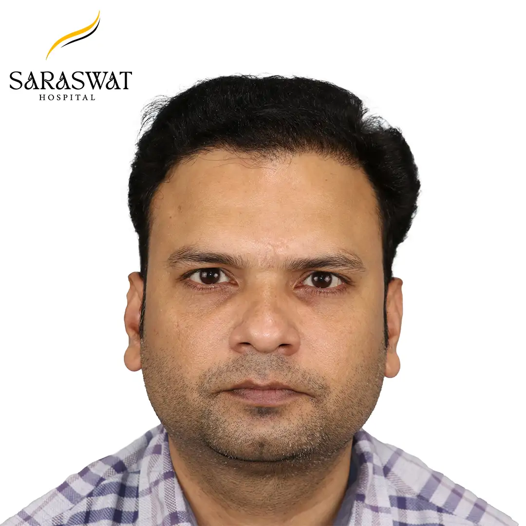 Hair Transplant Before and After Results