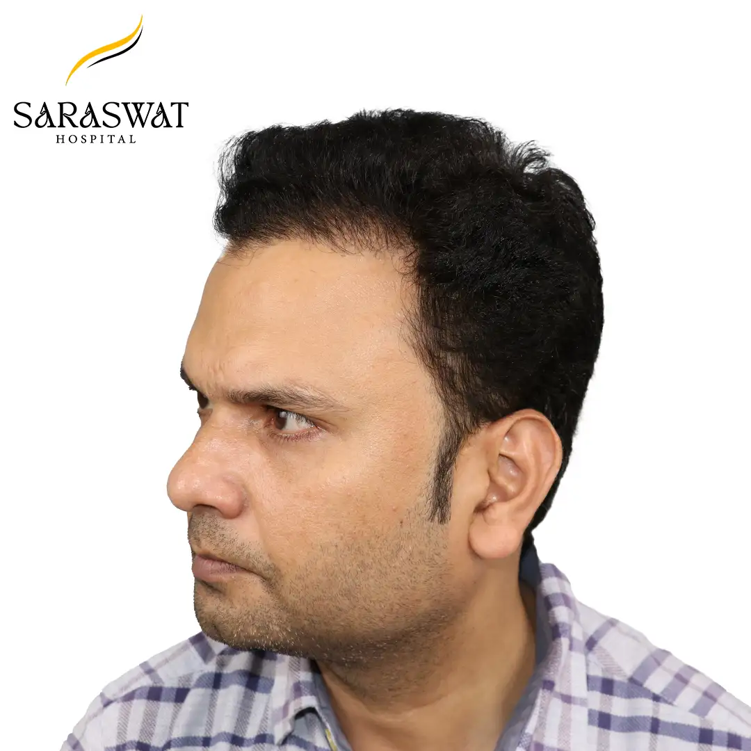 FUE Hair Transplant