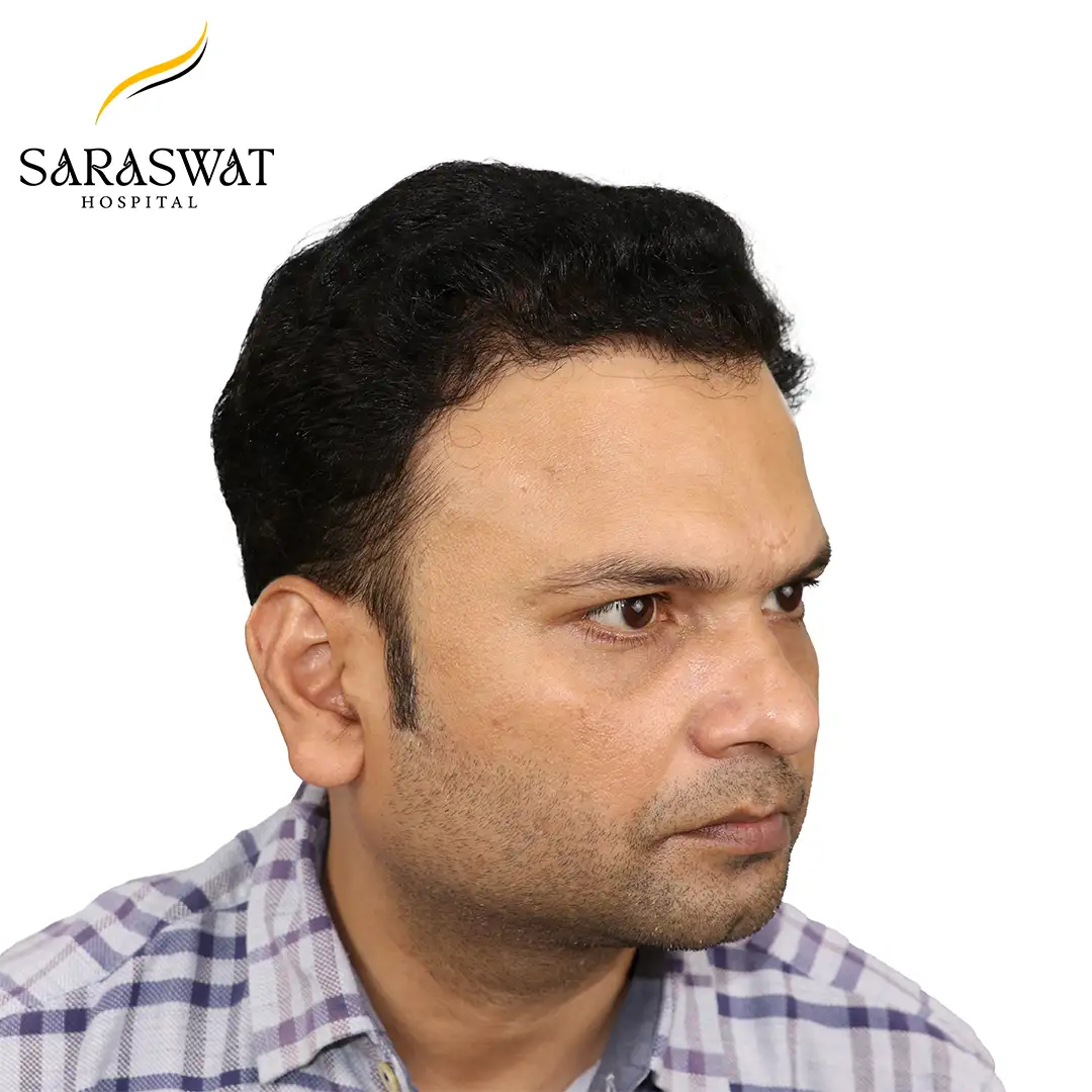 45 Degree Right FUE Hair Transplant Result After Procedure