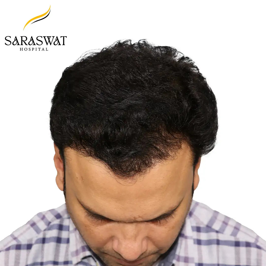 FUE Hair Transplant