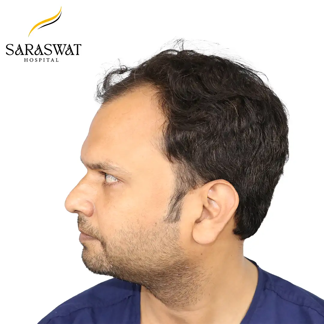 90 Degree Left FUE Hair Transplant Result Before Procedure