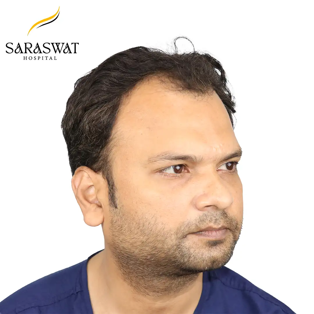 45 Degree Right FUE Hair Transplant Result Before Procedure