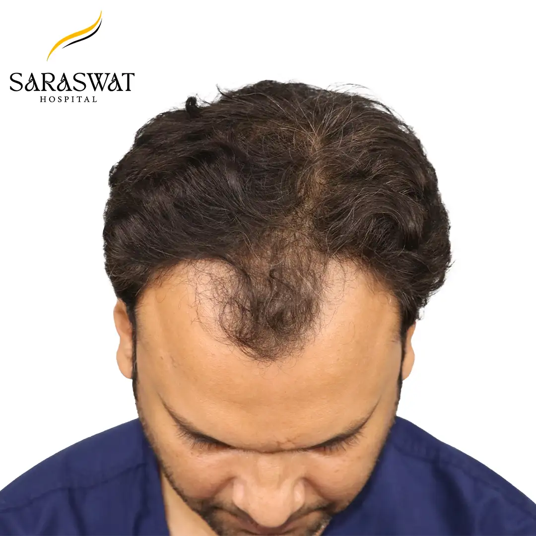 Hair Transplant Before and After Results