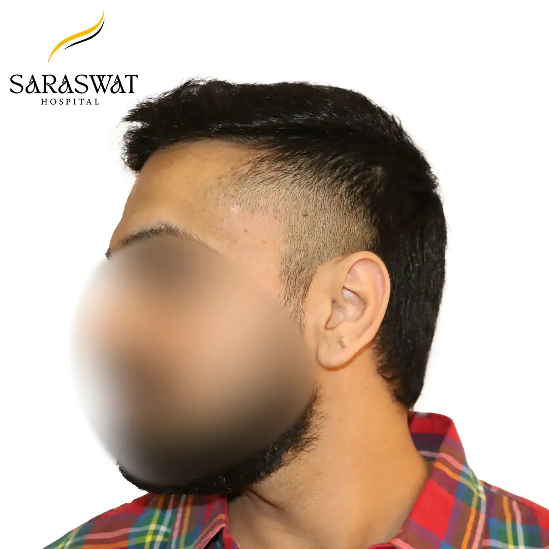 FUE Hair Transplant