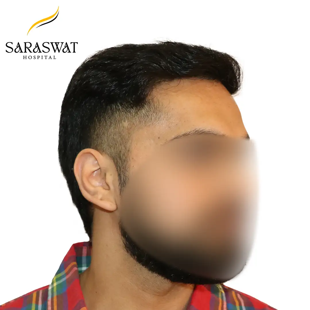 90 Degree Right FUE Hair Transplant Result After Procedure