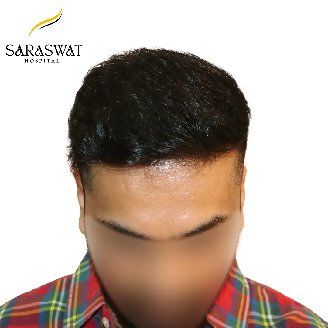 Hair Transplant Before After