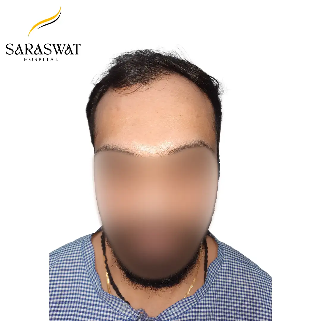 Front FUE Hair Transplant Result Before Procedure