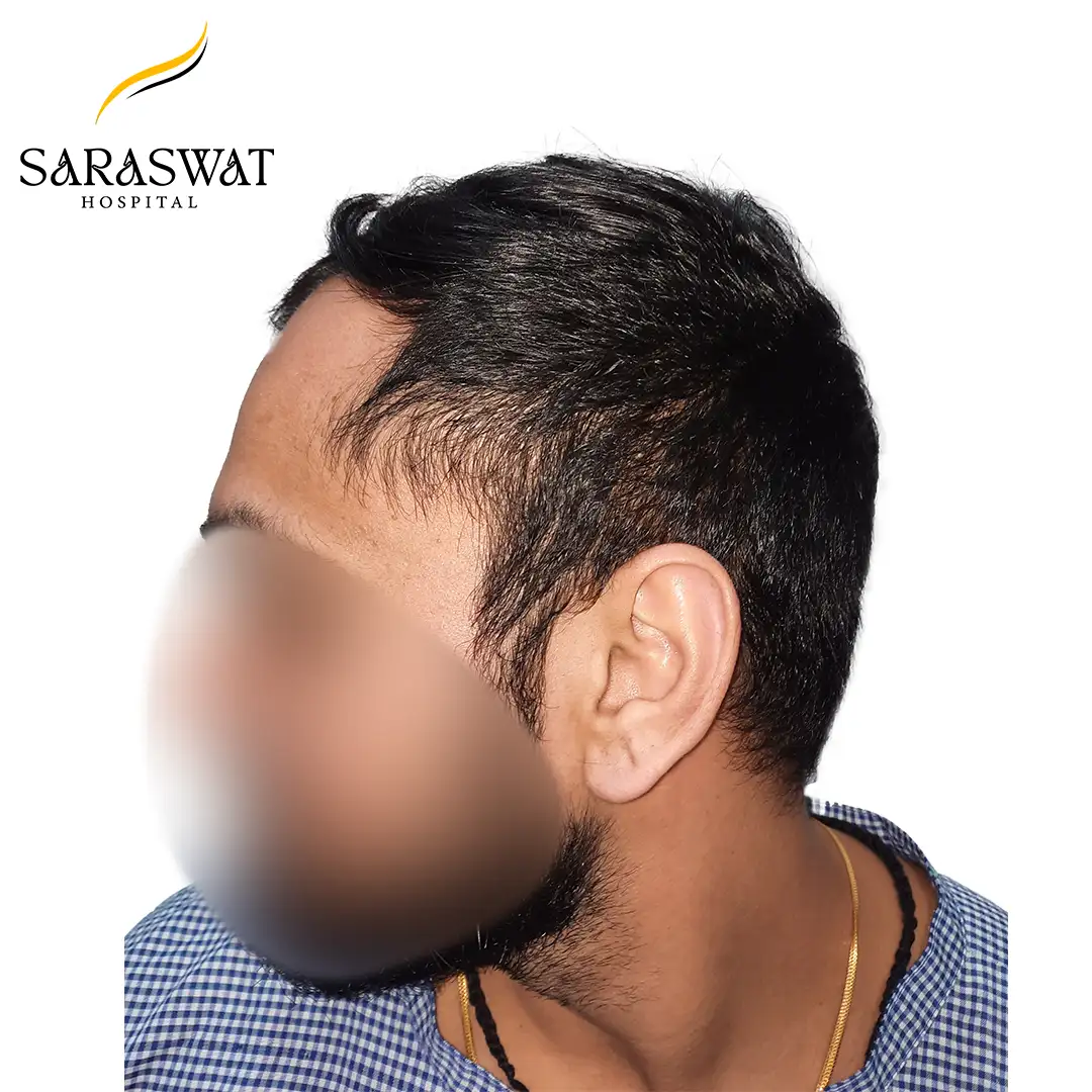 90 Degree Left FUE Hair Transplant Result Before Procedure