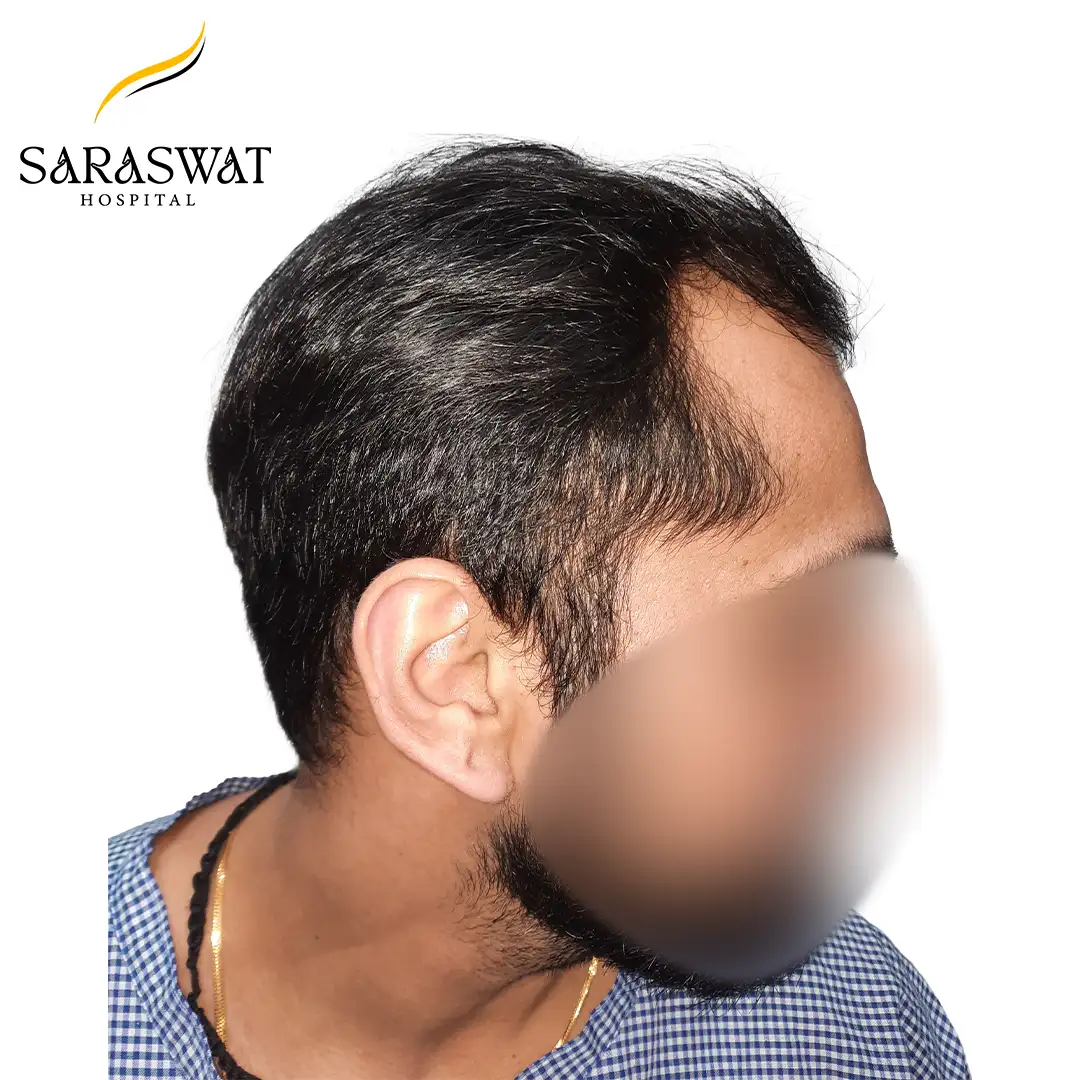 90 Degree Right FUE Hair Transplant Result Before Procedure
