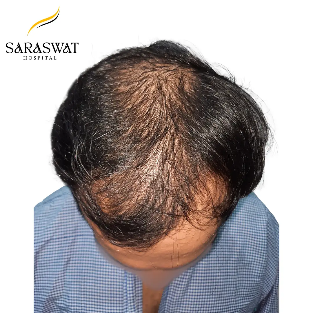 Hair Transplant Before After