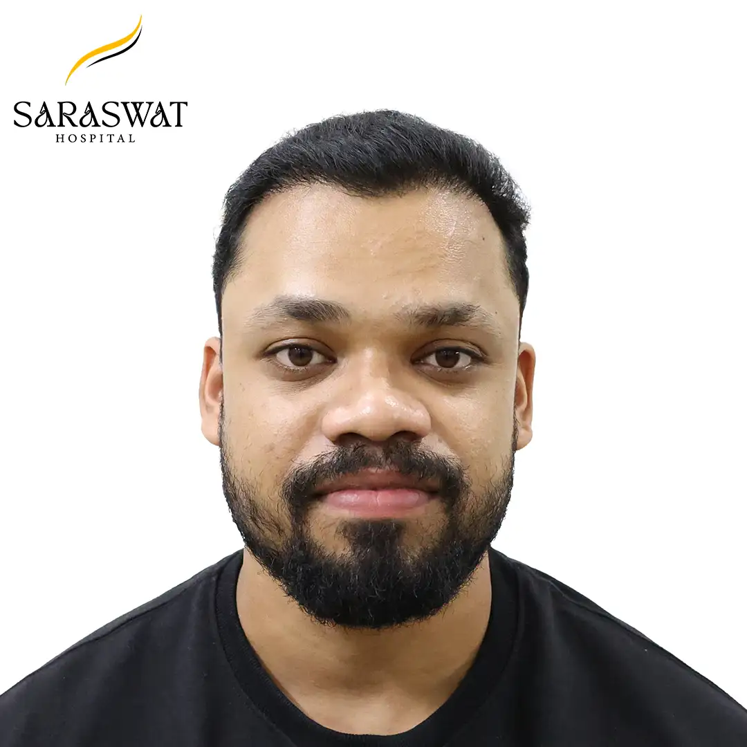 Front FUE Hair Transplant Result After Procedure