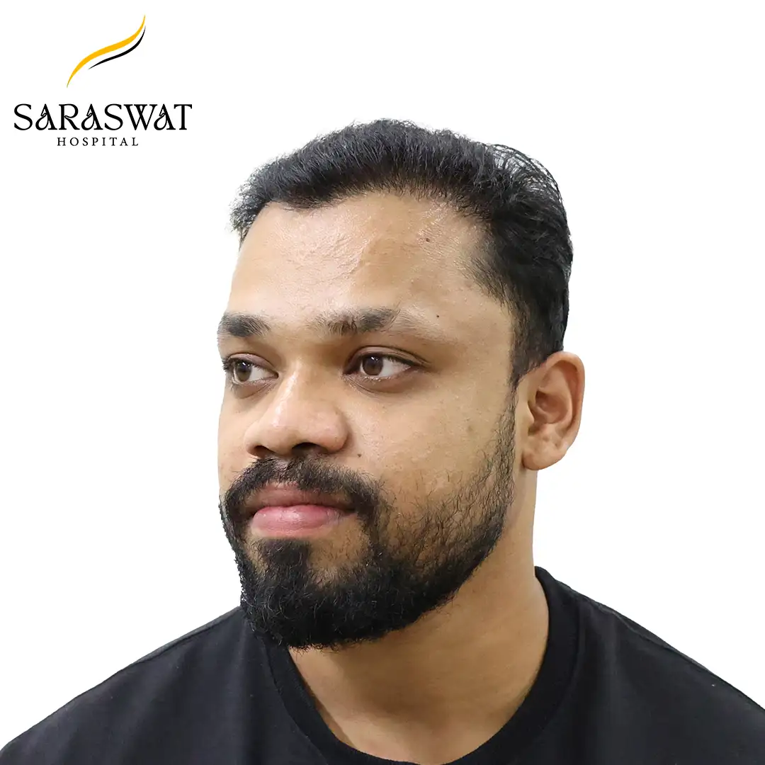 Hair Transplant Before and After