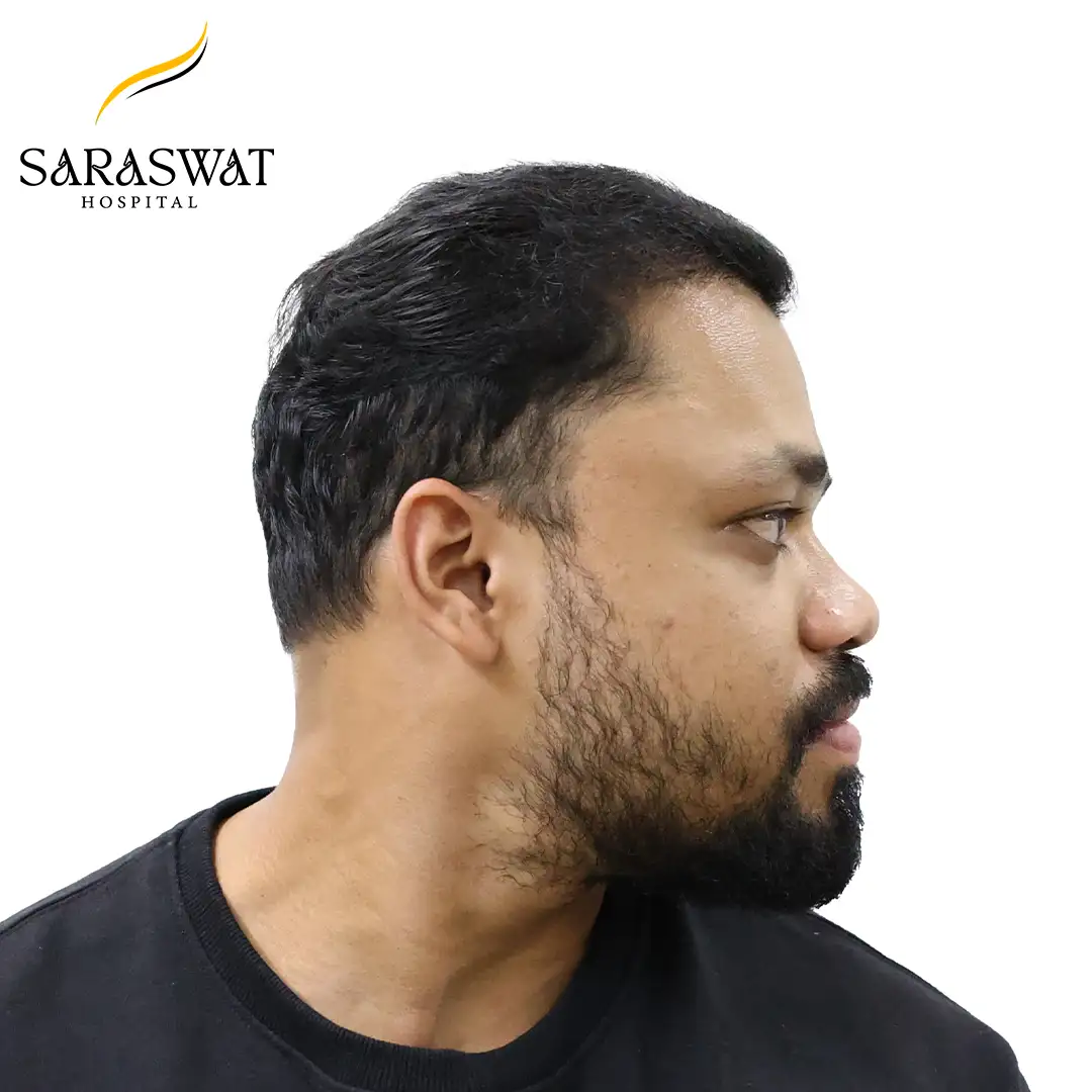 90 Degree Right FUE Hair Transplant Result After Procedure