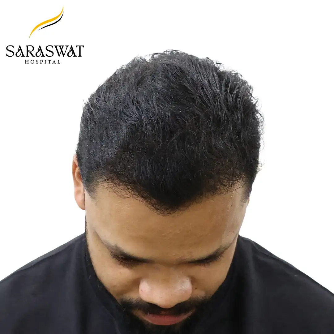 FUE Hair Transplant