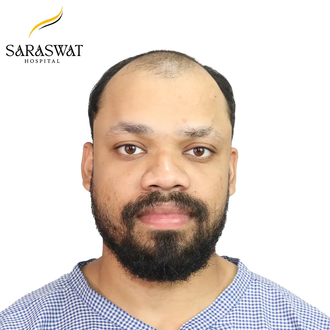 Front FUE Hair Transplant Result Before Procedure