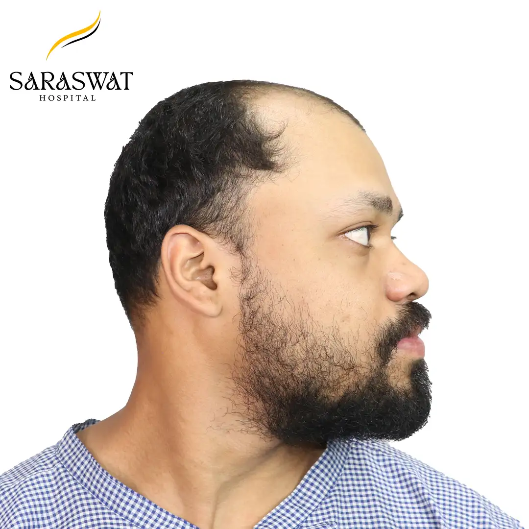 90 Degree Right FUE Hair Transplant Result Before Procedure