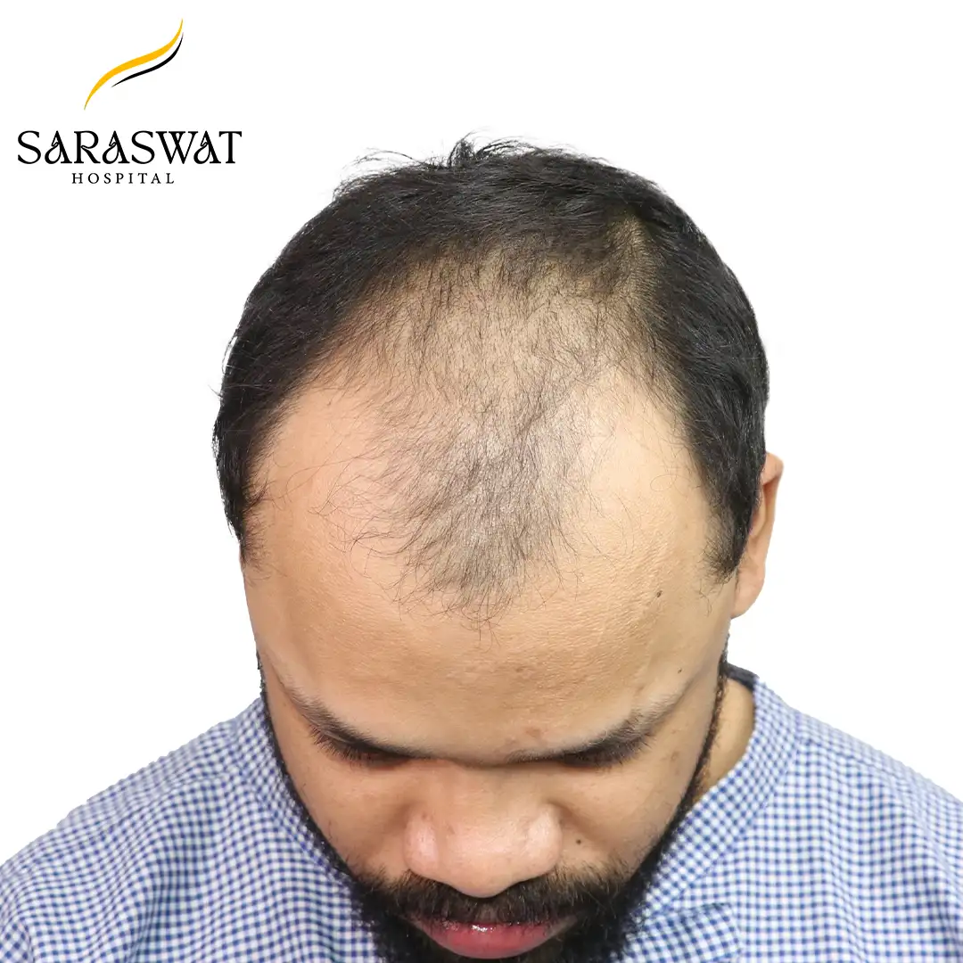 Top FUE Hair Transplant Result Before Procedure