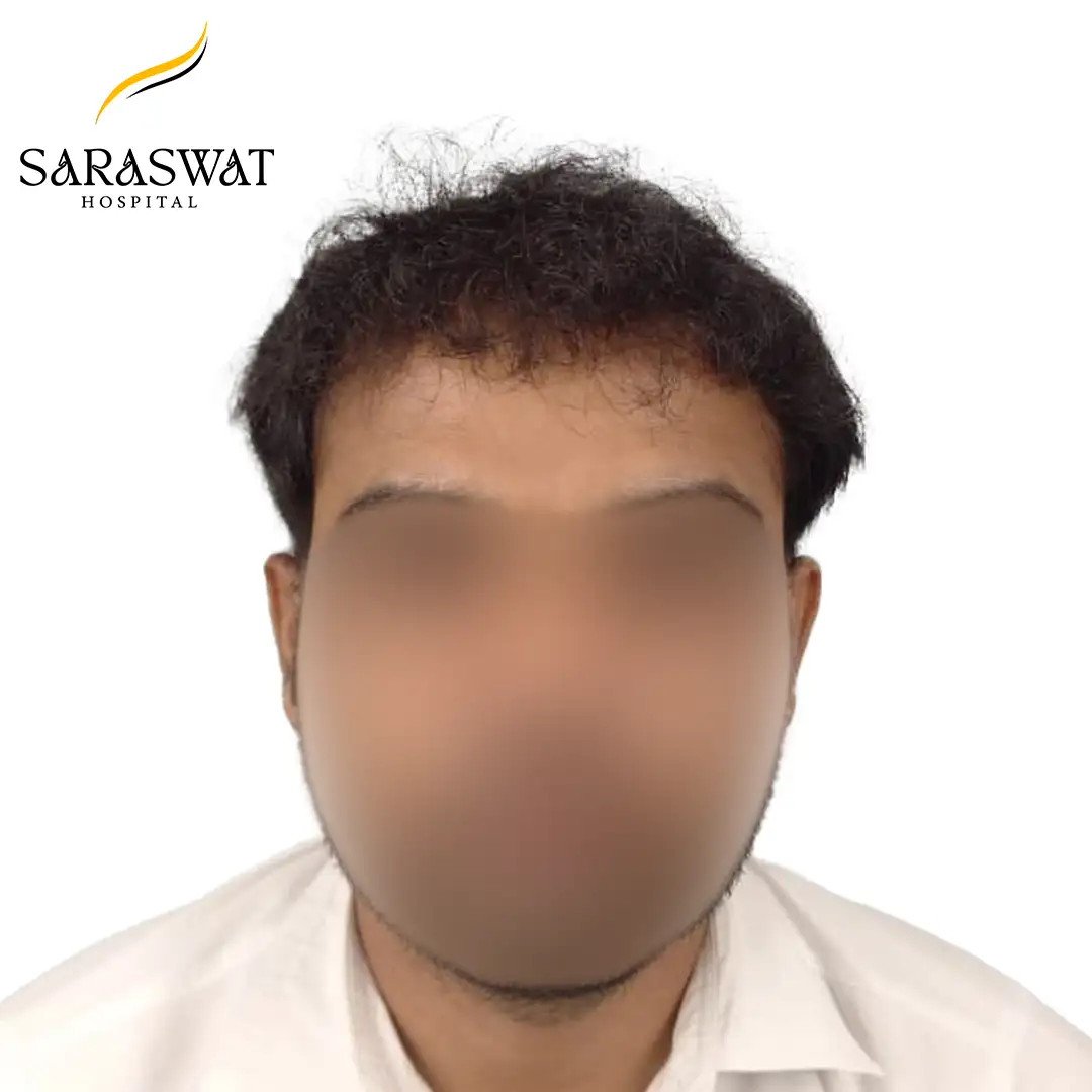 Front FUE Hair Transplant Result After Procedure