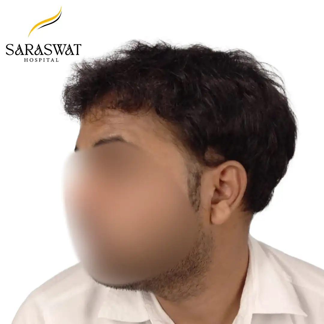 90 Degree Left FUE Hair Transplant Result After Procedure