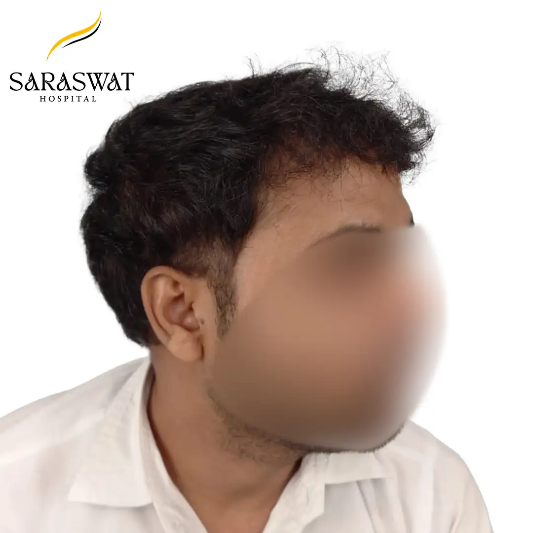 90 Degree Right FUE Hair Transplant Result After Procedure