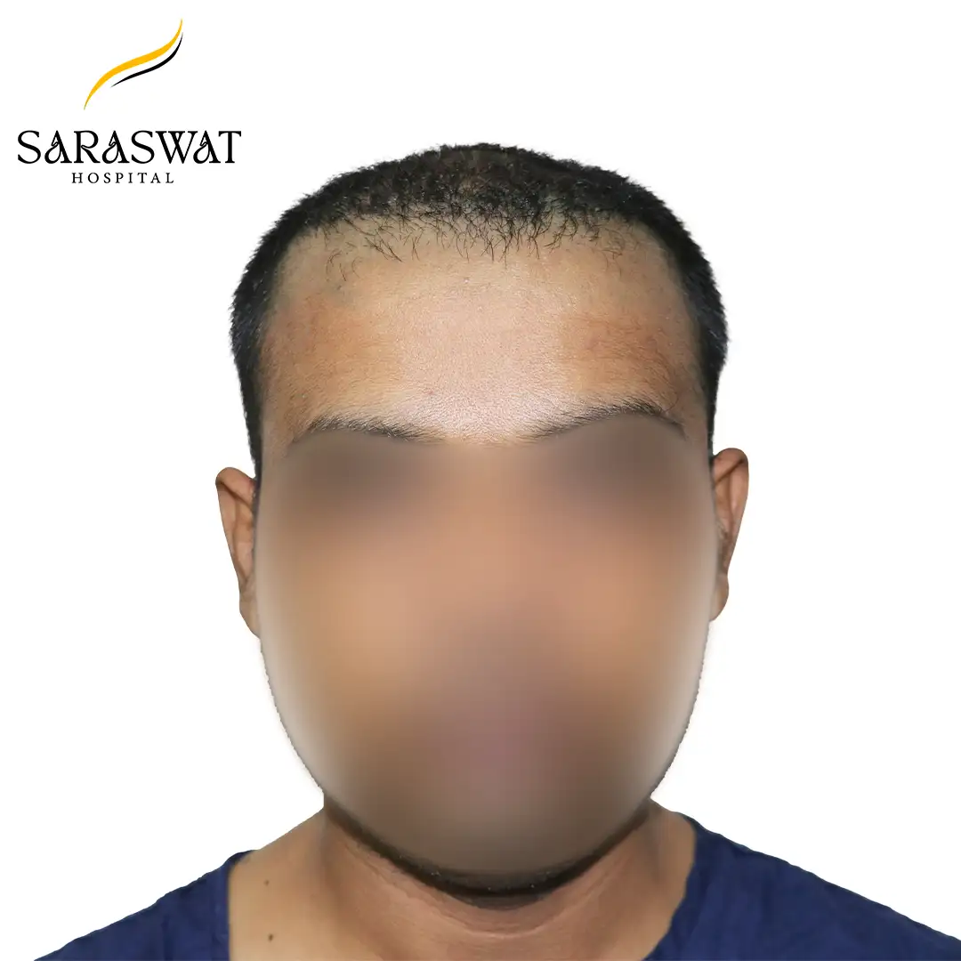 Front FUE Hair Transplant Result Before Procedure