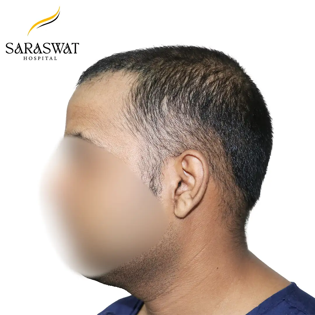90 Degree Left FUE Hair Transplant Result Before Procedure