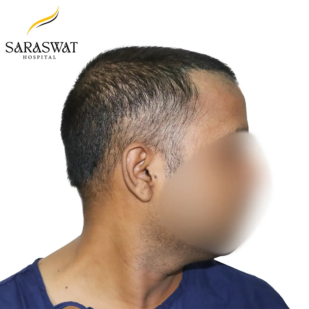 90 Degree Right FUE Hair Transplant Result Before Procedure