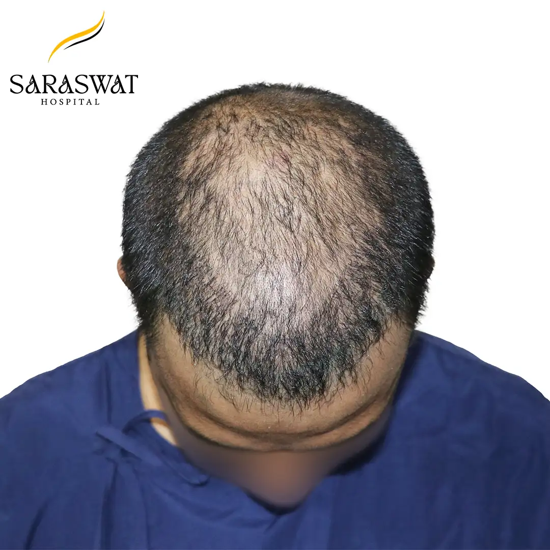 Top FUE Hair Transplant Result Before Procedure