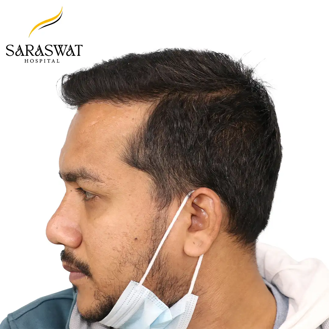 Hair Transplant Before After