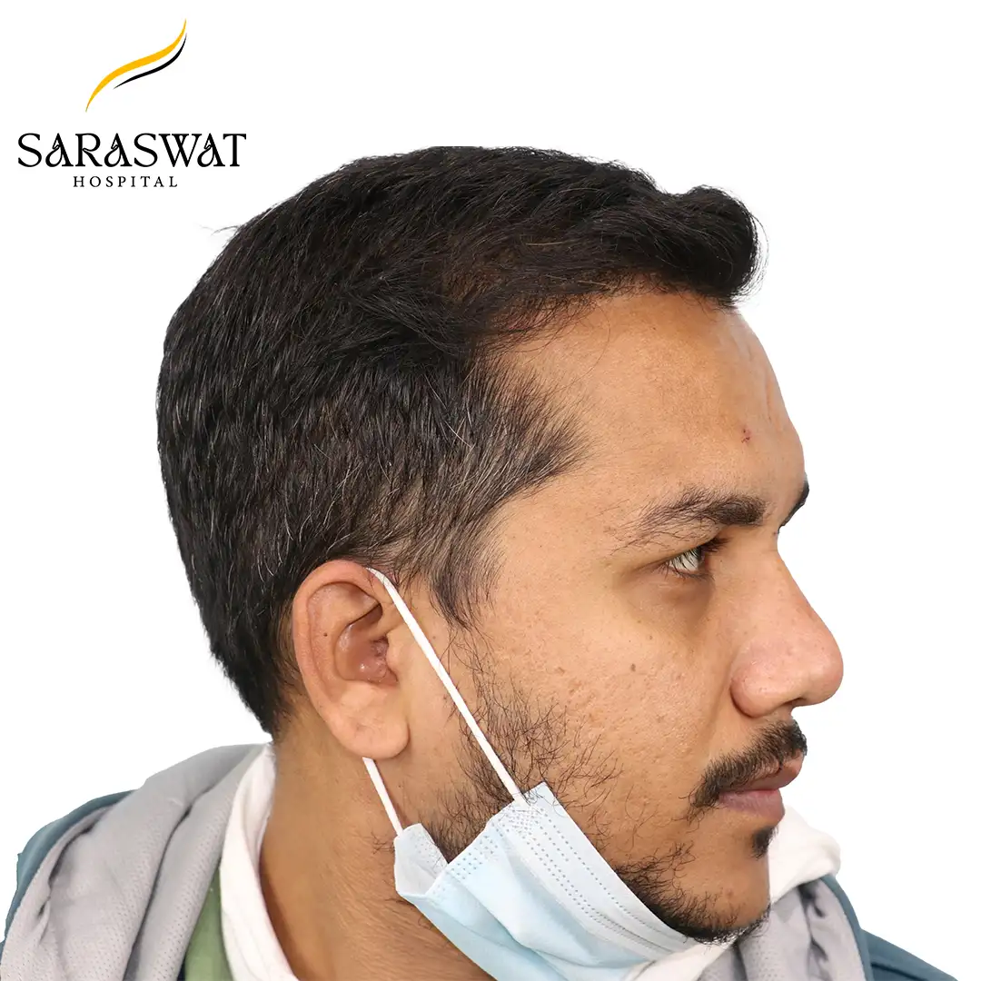 Hair Transplant Before and After Results