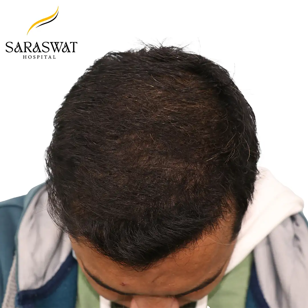 FUE Hair Transplant