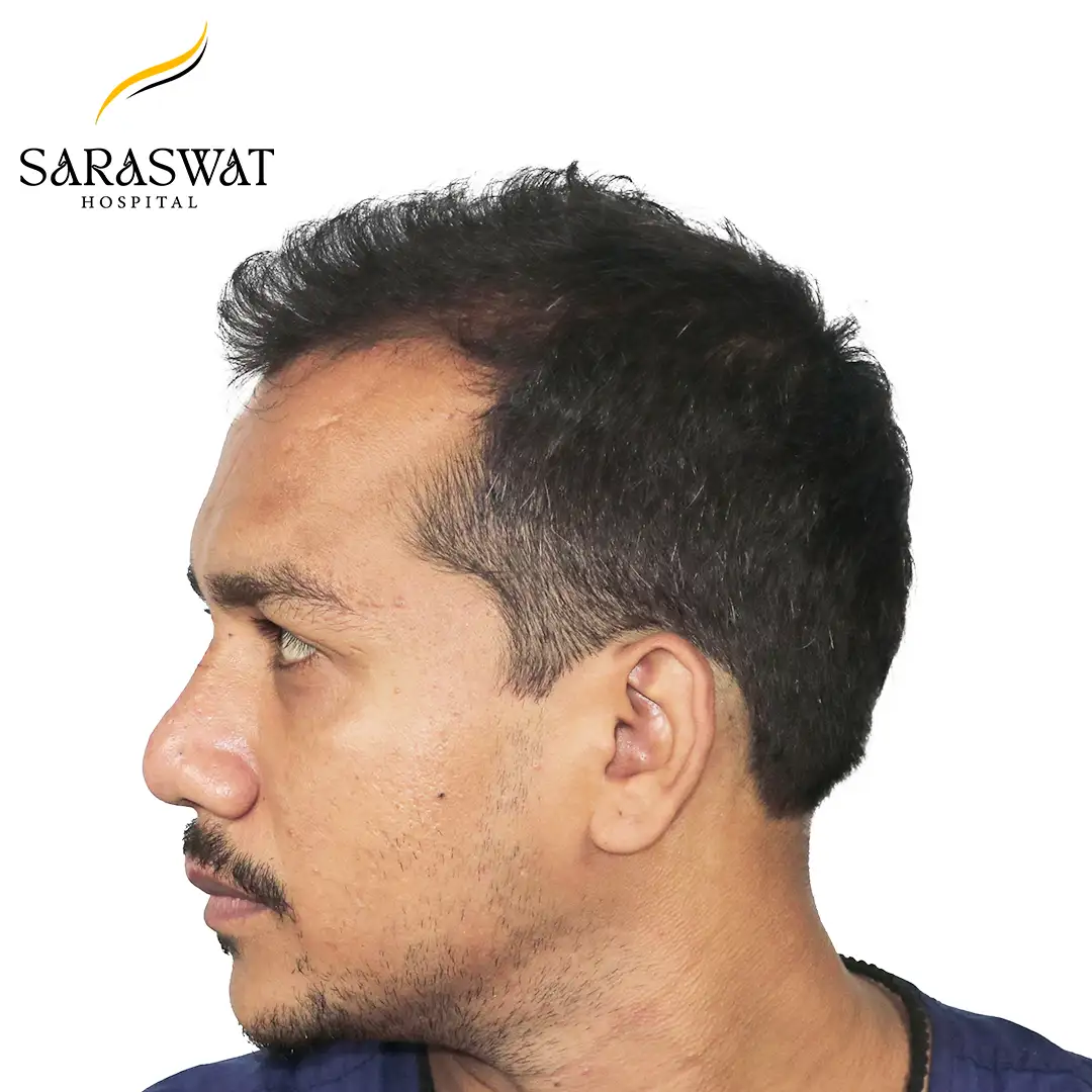 Hair Transplant Before After