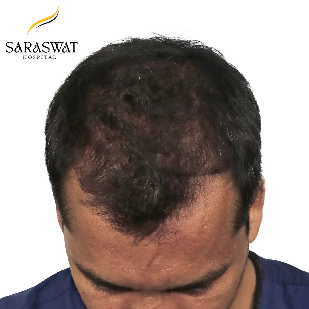 FUE Hair Transplant