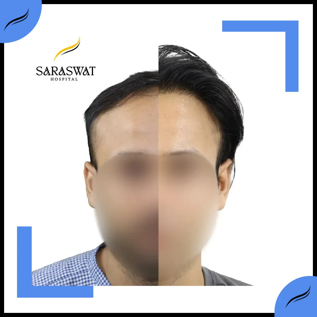 Hair Transplant Before and After | Hair Transplant Results