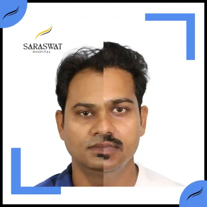 Hair Transplant Before and After