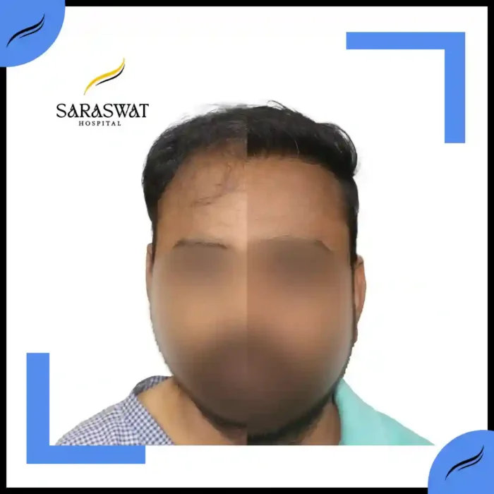 Hair Transplant Before and After