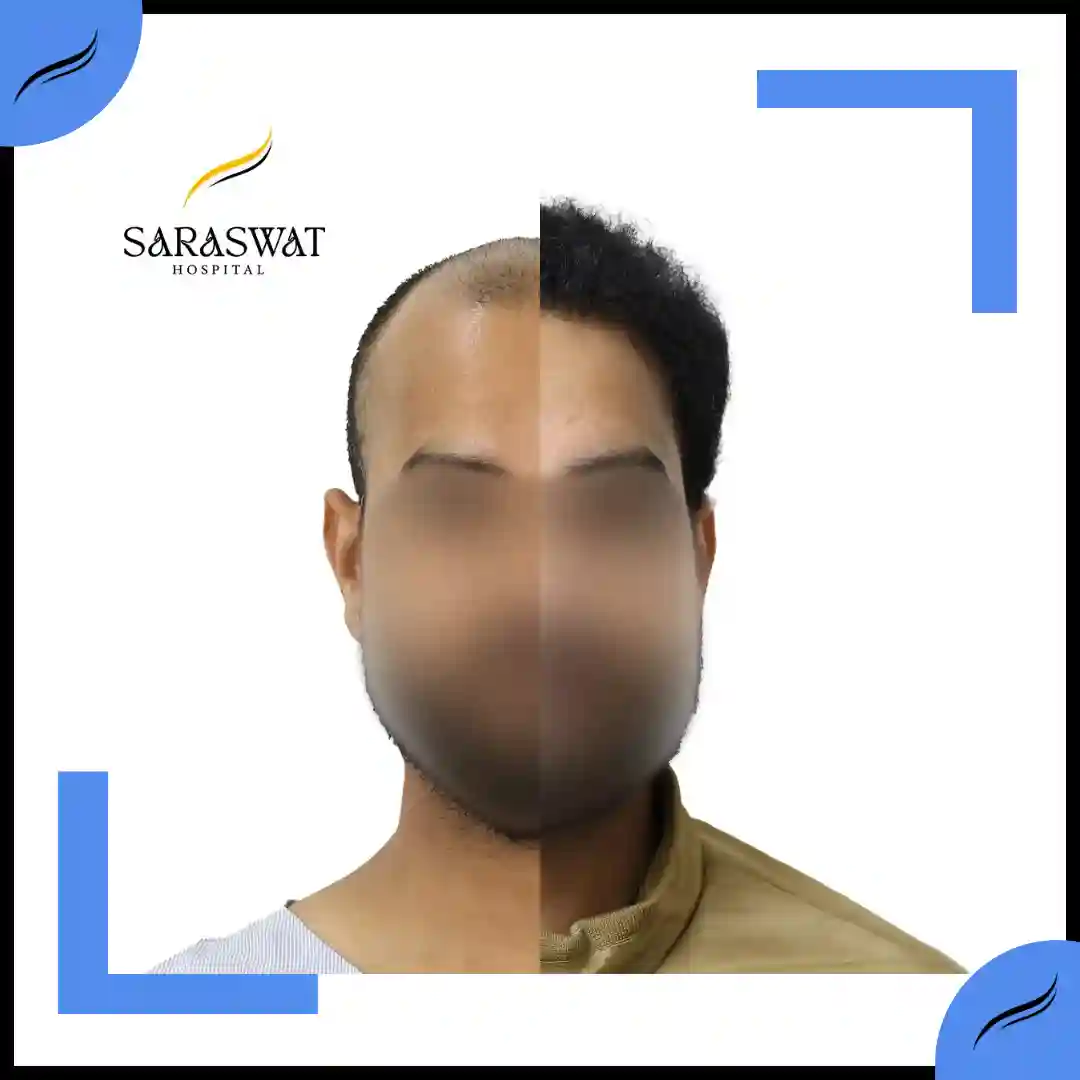 Hair Transplant Before and After