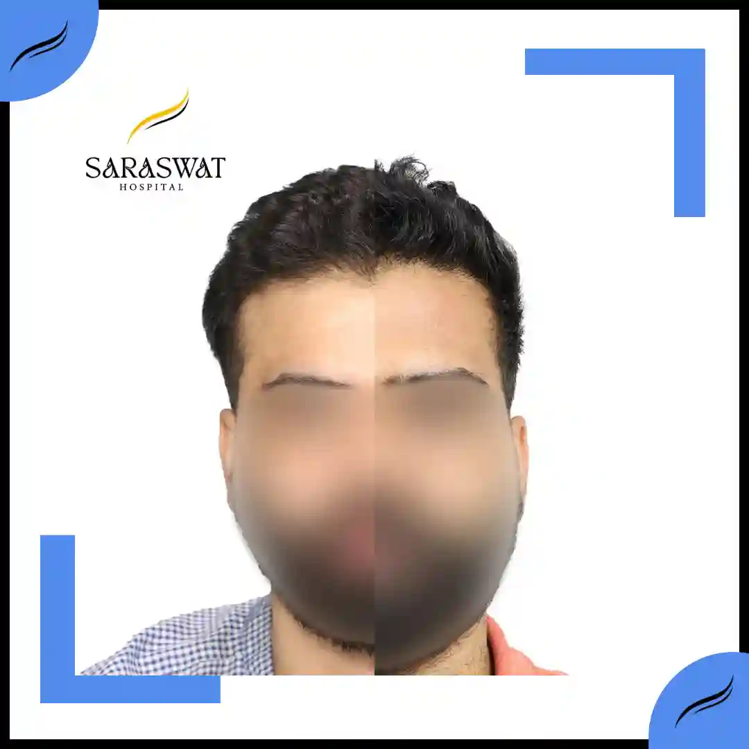 Hair Transplant Before and After