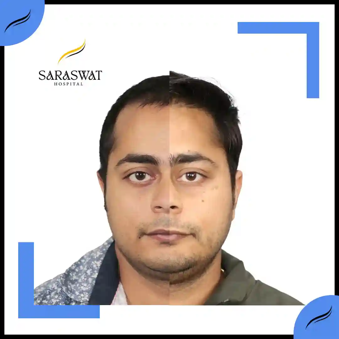 Hair Transplant Before and After