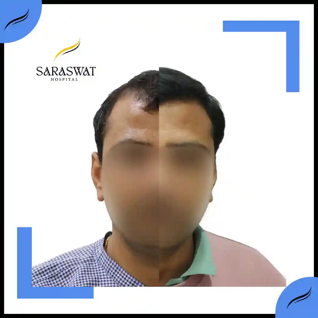 Hair Transplant Before and After