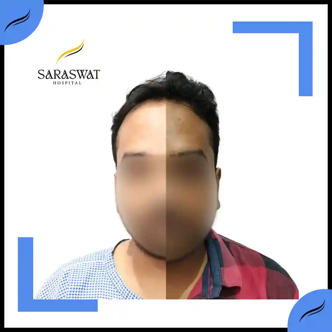 Hair Transplant Before and After