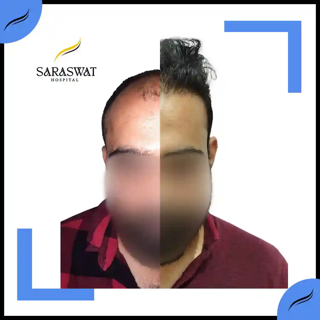 Hair Transplant Before and After