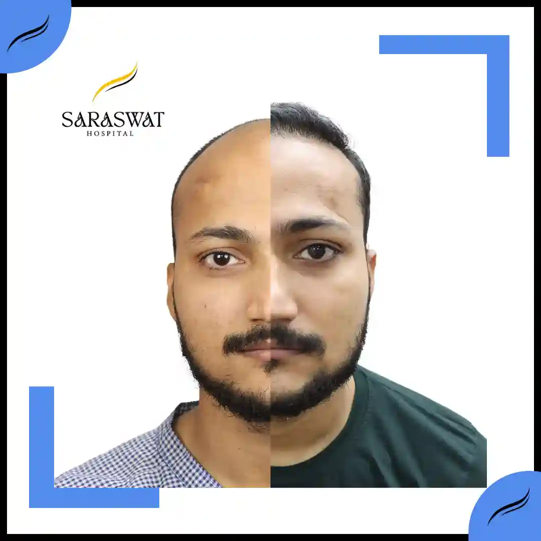 Hair Transplant Before and After